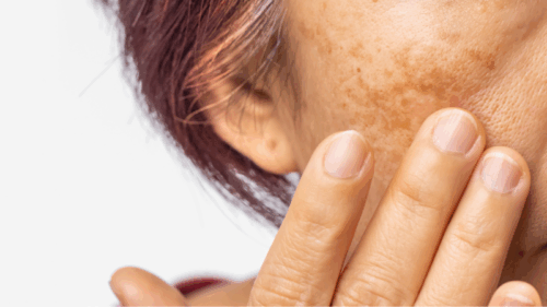 mano che tocca il viso con macchie solari 